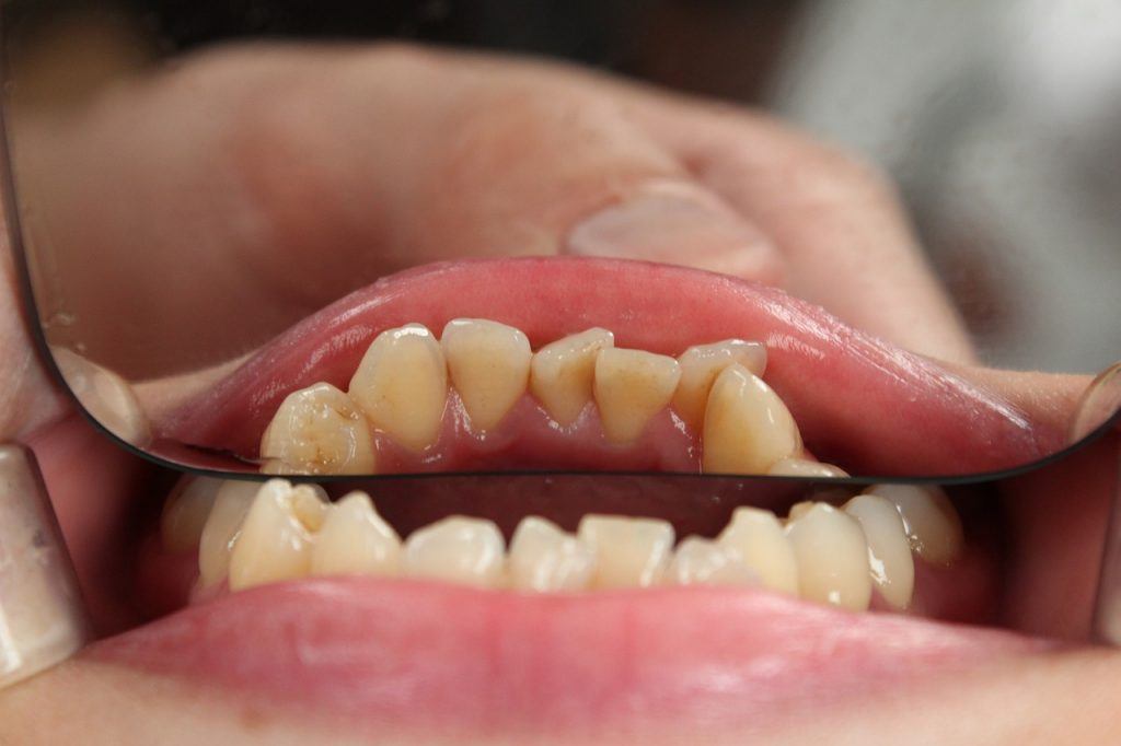  Was bedeutet es, von schiefen Zähnen zu träumen?